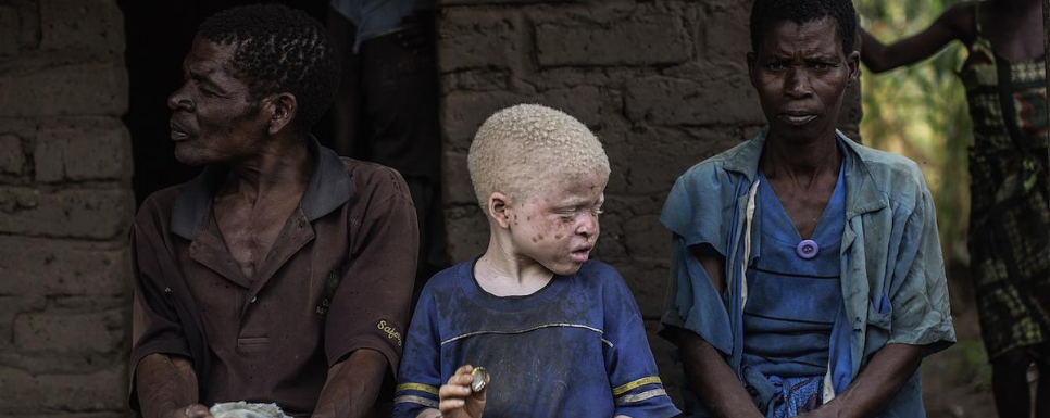 Mutilación y muerte: así es la vida de los albinos en África
