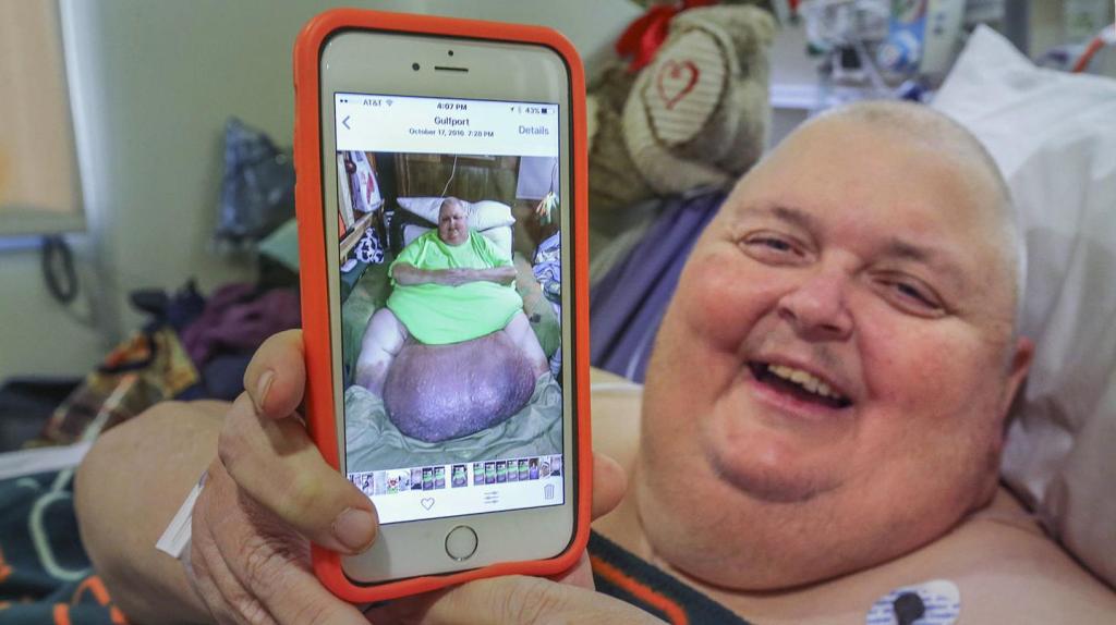 Die Ärzte sagten, es sei “nur Fett”, jetzt wurde diesem Mann endlich sein 60-Kilo-Tumor entfernt