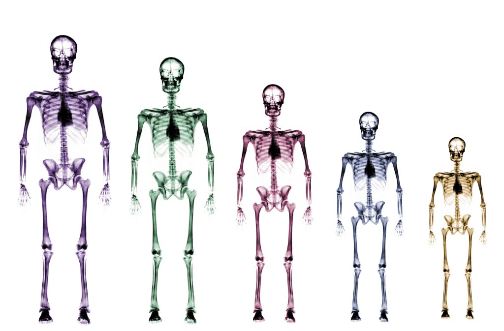 Should Short Kids Take Growth Hormones?