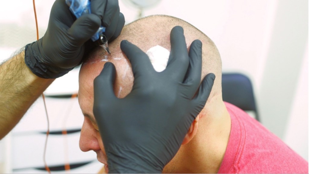 I Got My Head Tattooed to Make My Hair Look Thicker