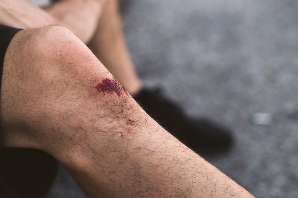 Wounds Take Longer to Heal If You Get Them at Night