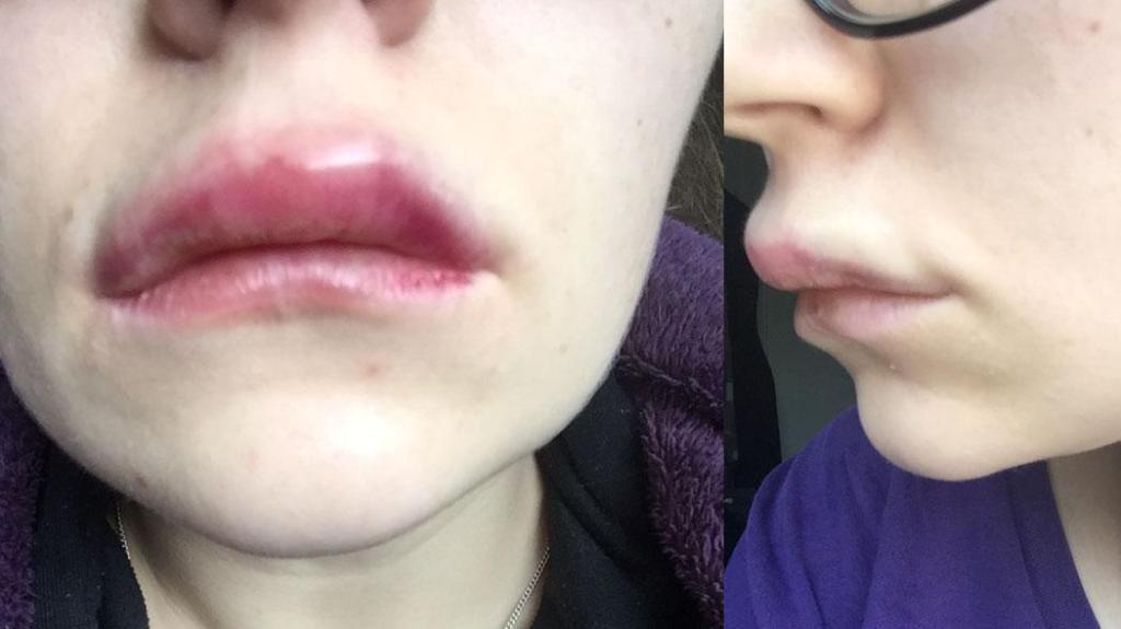 The Rise of Lip Fillers Gone Wrong