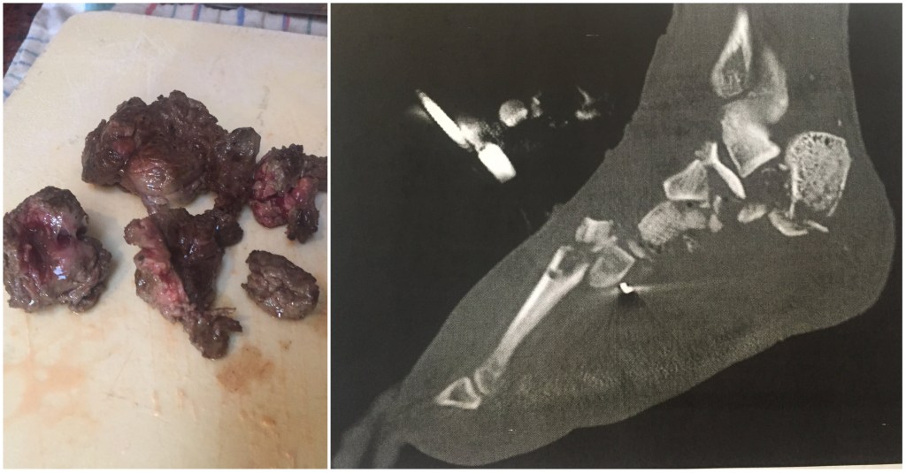 Een guy serveerde taco’s aan zijn vrienden gevuld met z’n eigen geamputeerde been