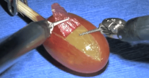 They did surgery on a grape meme