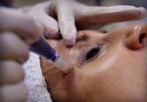 Woman getting microneedling facial done