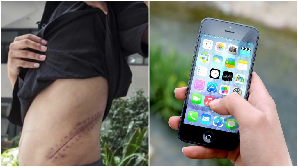 Nastolatek, który oddał nerkę za iPhone’a, resztę życia spędzi przykuty do łóżka