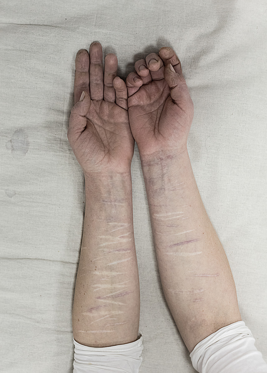 self inflicted wounds