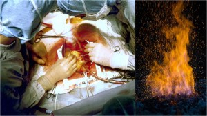 Des chirurgiens australiens ont accidentellement mis le feu à un patient