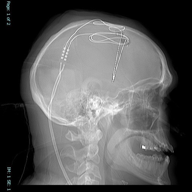 brain-implant-for-opioid-addiction
