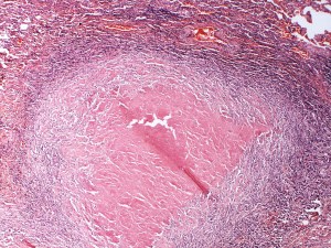 Eine rosa Masse zeigt Syphilis-Geschwülste, während AIDS rückläufig ist, ist die