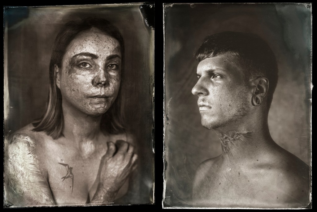 A Photographer and a Burn Survivor Find Beauty in Scars