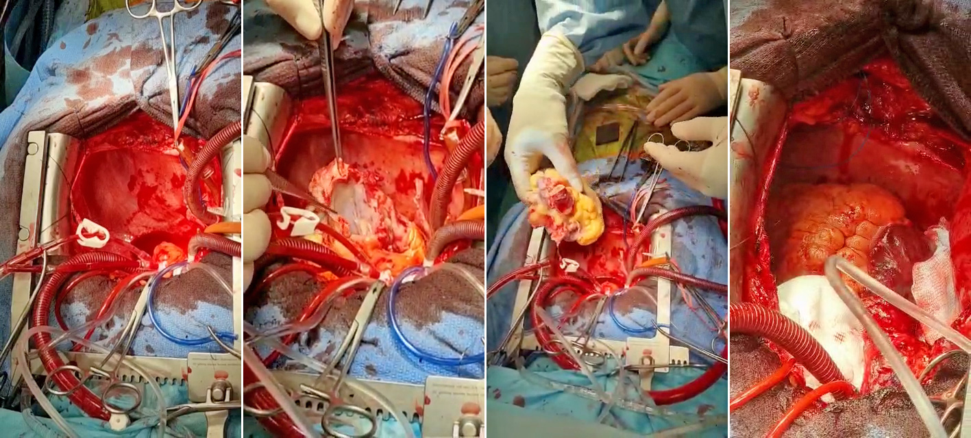 doctor horatiu moldovan, transplant de inima in romania, doctor care face transplant de inima in bucuresti