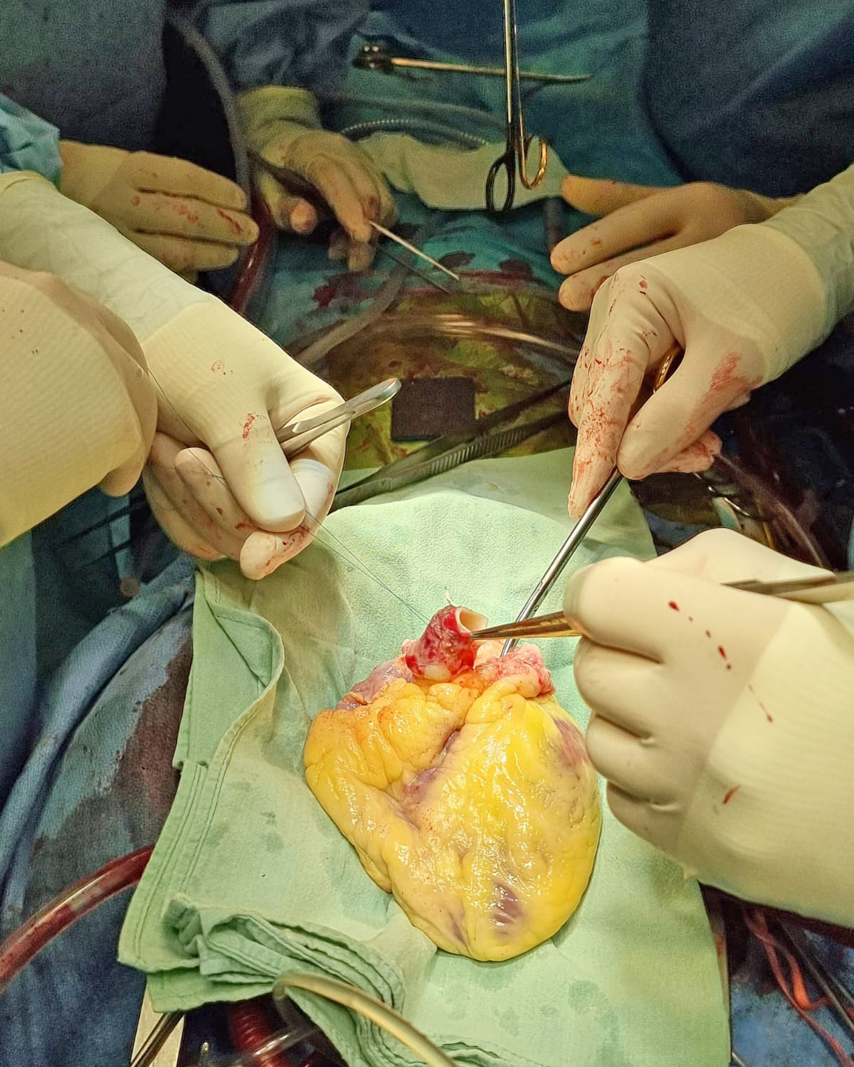 doctor horatiu moldovan, transplant de inima in romania, doctor care face transplant de inima in bucuresti