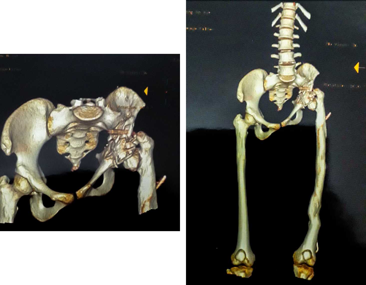 gheorghe burnei operatii amira hamed victime chirurgie ortoped abuz malprax radiografie