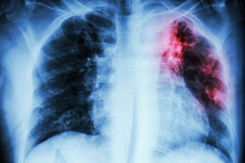 theres-a-massive-tuberculosis-outbreak-in-the-us