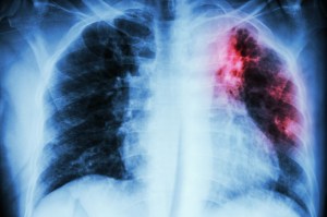 theres-a-massive-tuberculosis-outbreak-in-the-us