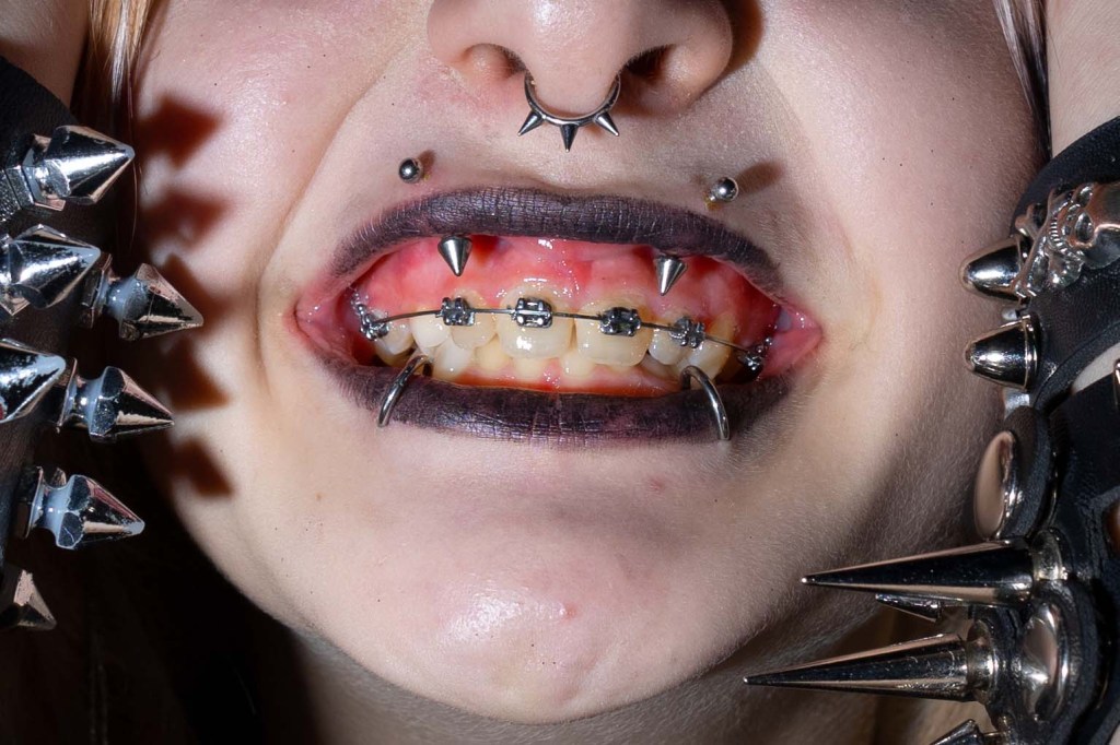 A close up of a face featuring a nose ring, piercings, and braces.