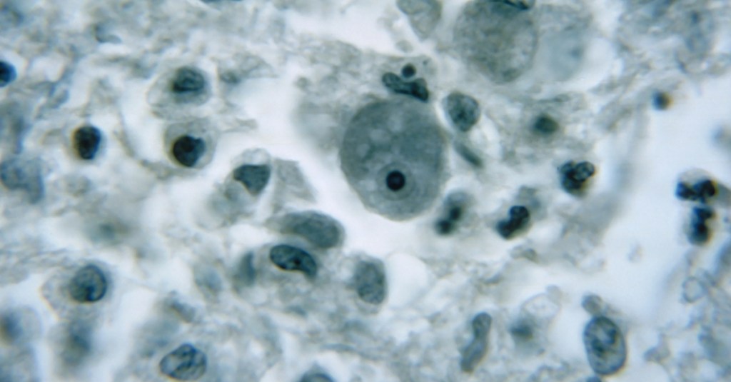 She Just Wanted Clear Sinuses. A Brain-Eating Amoeba Killed Her.